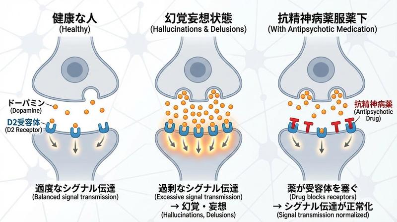 多巴胺与精神分裂症突触图